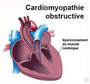 cardiopathie C